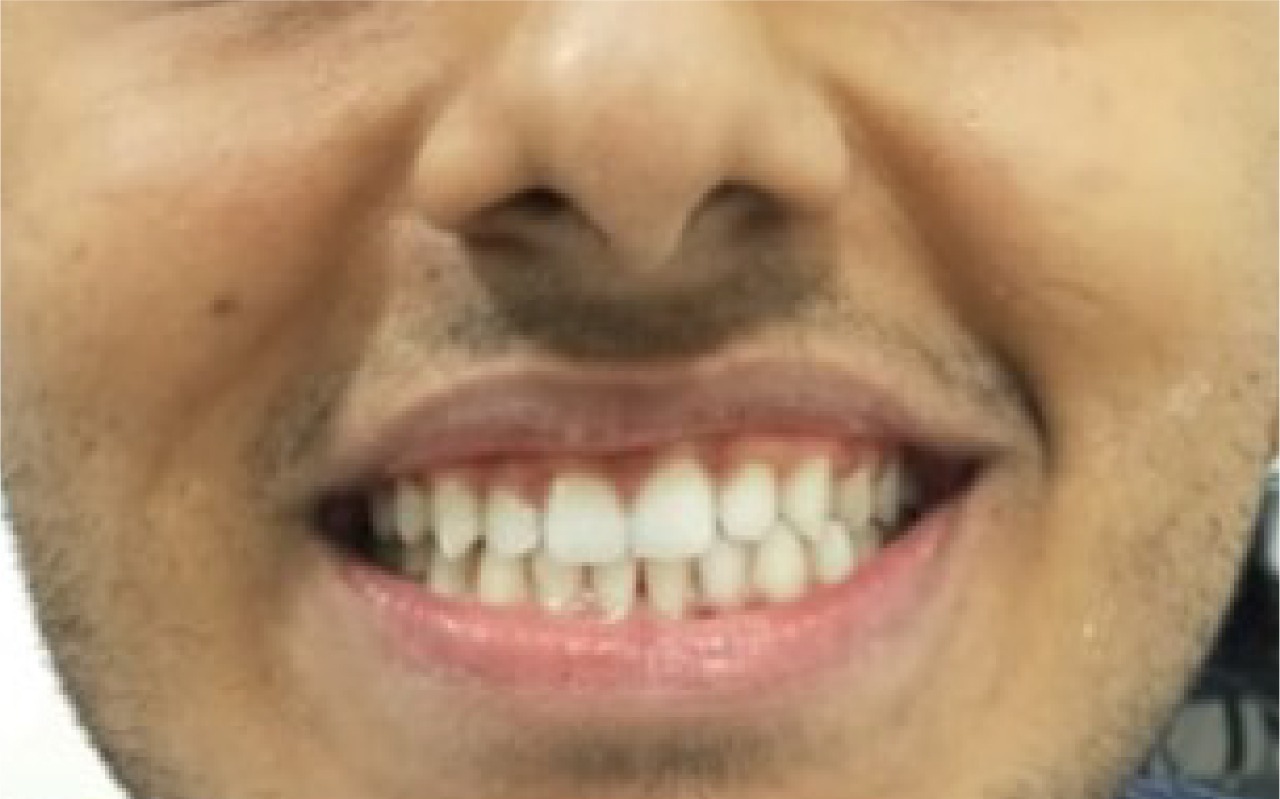 After smile transformation 1