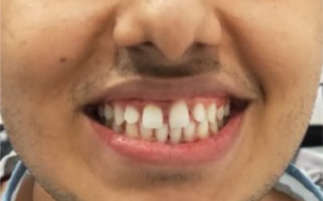 Before smile transformation 1