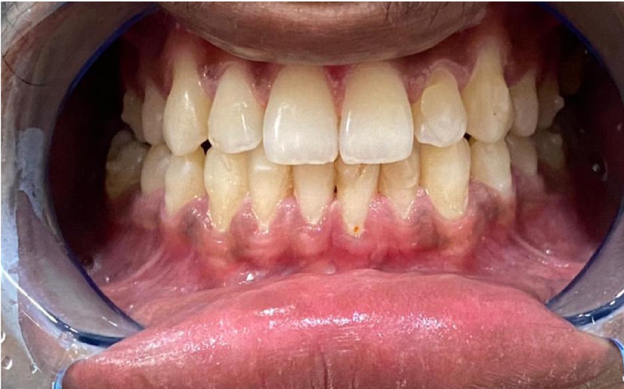 After smile transformation 2