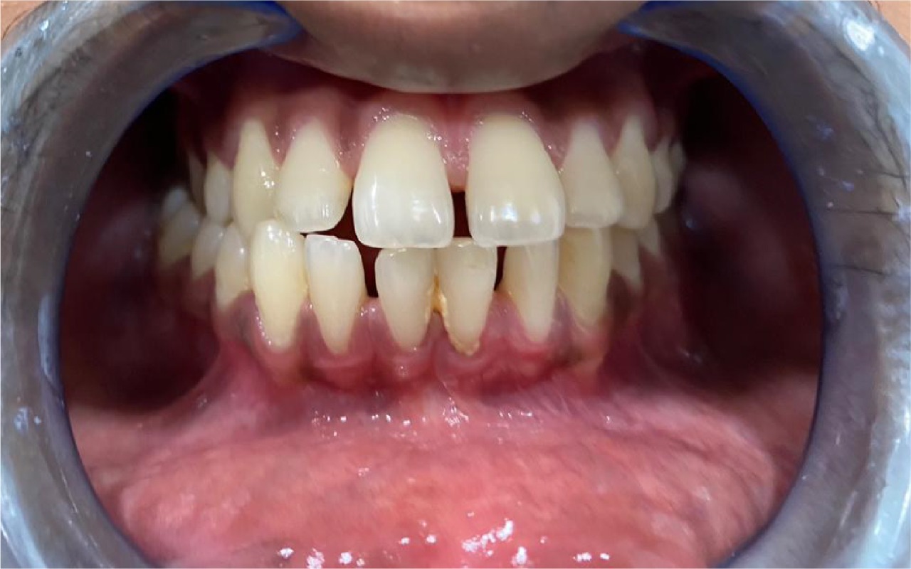 Before smile transformation 2