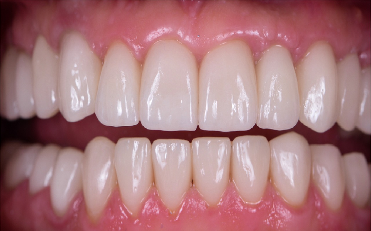 After smile transformation 3