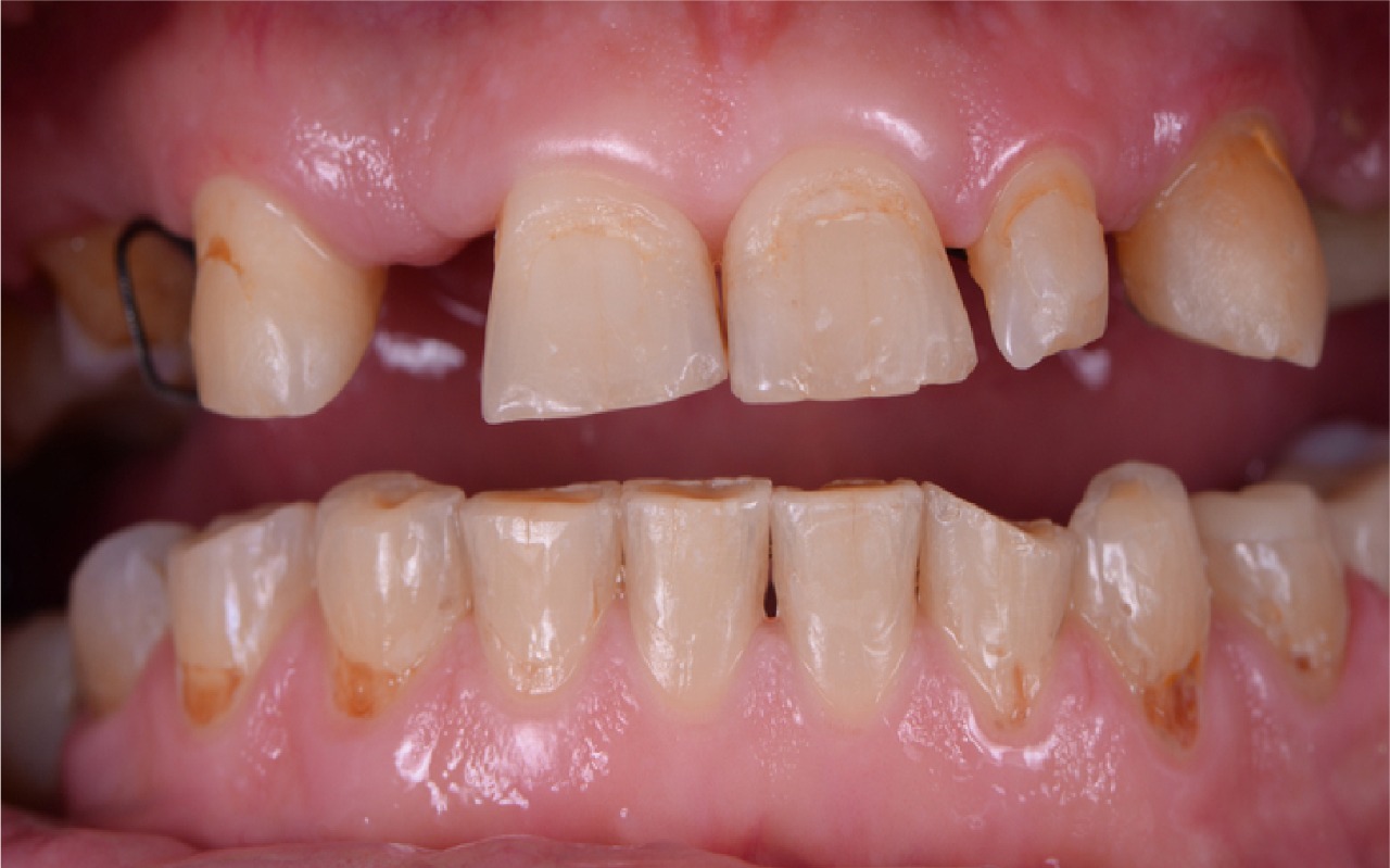 Before smile transformation 3