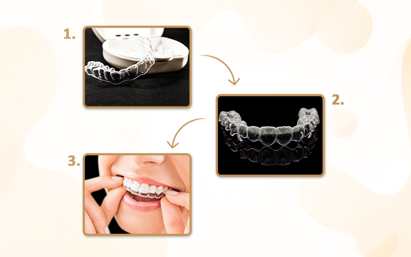 Orthodontic treatment process illustration for Flexismile