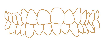 Crowded teeth illustration