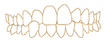 Crossbite illustration