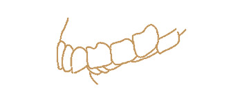 Overjet illustration