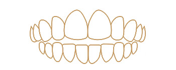 Open bite illustration