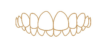 Deep bite illustration