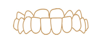 Class 3 or reverse bite illustration
